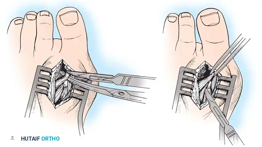 Disorders of the Hallux Surgical Diagram