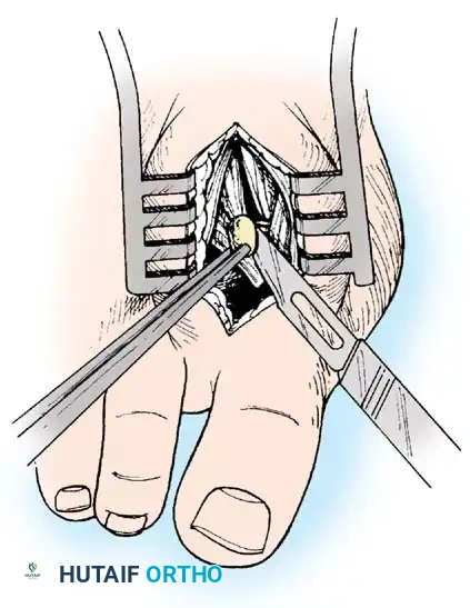 Fig. 78-20 Modifi ed McBride procedure. Fibular sesamoid is removed.