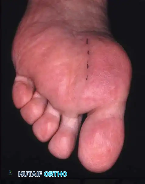 Fig. 78-21 Fibular sesamoidectomy (plantar approach). A, Incision. B, Common digital nerve to fi rst web space.