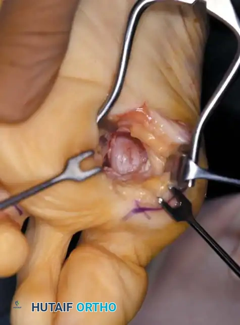 Fig. 78-21 Fibular sesamoidectomy (plantar approach). A, Incision. B, Common digital nerve to fi rst web space.
