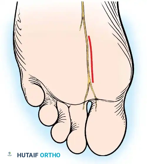 Fig. 78-21 Fibular sesamoidectomy (plantar approach). A, Incision. B, Common digital nerve to fi rst web space.