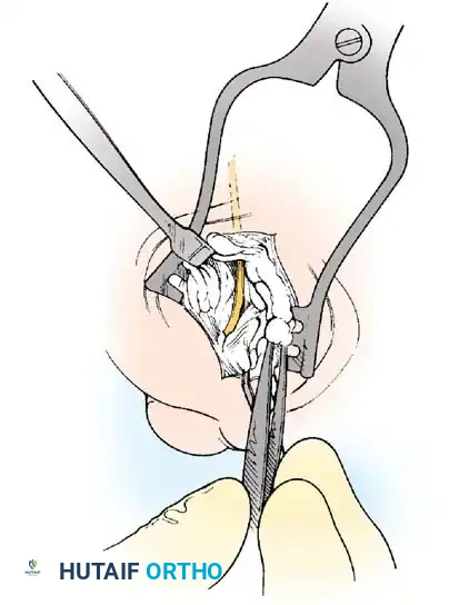 Fig. 78-21 Fibular sesamoidectomy (plantar approach). A, Incision. B, Common digital nerve to fi rst web space.