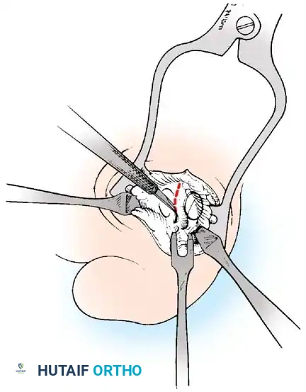 Disorders of the Hallux Surgical Diagram