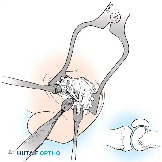 Disorders of the Hallux Surgical Diagram