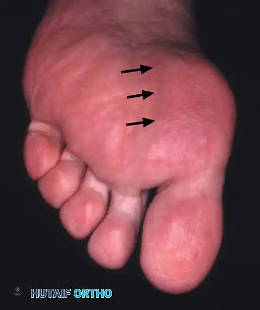Fig. 78-21, cont’d C, Flexor hallucis longus tendon is retracted medially, and neurovascular bun– dle is retracted laterally; intersesamoid ligament is divided. D, Fibular sesamoid ligament is removed, and lateral border of tibial sesamoid is exposed. E, Tendon of oblique head of adductor hallucis. F, Healed plantar incision.