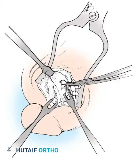 Disorders of the Hallux Surgical Diagram