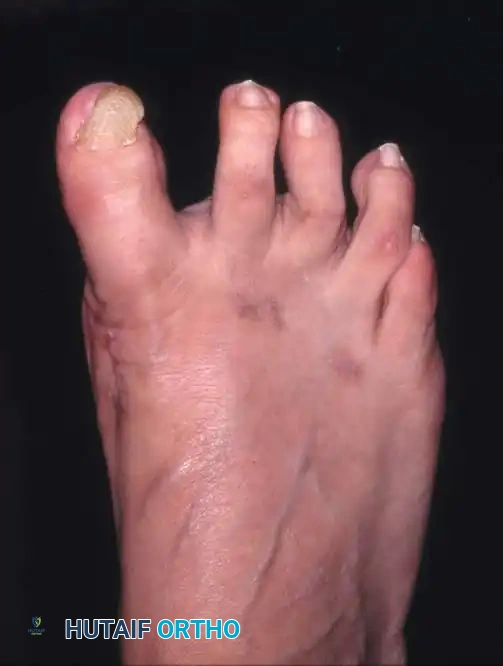 Fig. 78-22 Modifi ed McBride procedure. Medial capsule is imbricated, with plantar fl ap over dorsal fl ap. Inset, Cross section through metatarsal head.