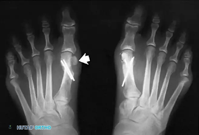 Fig. 78-22 Modifi ed McBride procedure. Medial capsule is imbricated, with plantar fl ap over dorsal fl ap. Inset, Cross section through metatarsal head.
