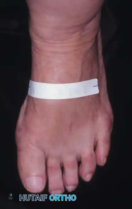 Fig. 78-29 Severe hallux valgus with bursa formation in 70-year-old woman. A and B, Anteroposterior and lateral clinical photographs of patient’s right foot. C, Correction of deformity by modifi ed Keller procedure. D, Preoperative and postoperative weight bearing radiographs of same patient.