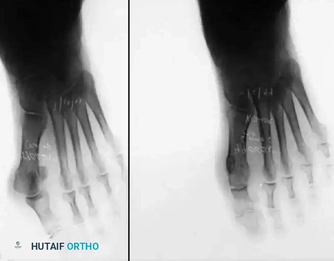 Disorders of the Hallux Surgical Diagram