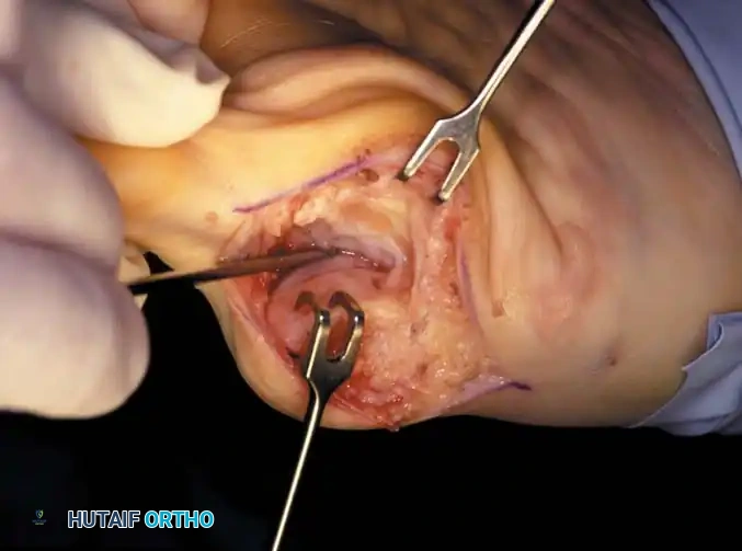 Disorders of the Hallux Surgical Diagram
