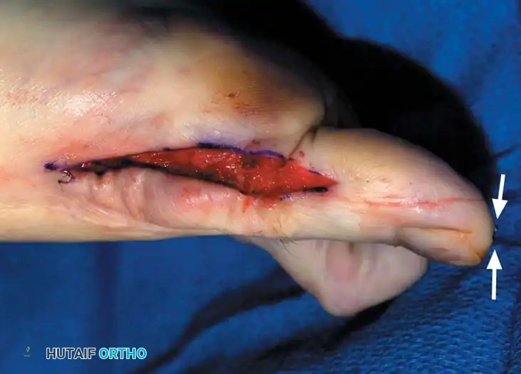 Fig. 78-31, cont’d F, Two 0.062-inch Kirschner wires are drilled distally. G, First metatarsal head is manually displaced laterally, and hallux is placed end-on the fi rst metatarsal. Kirschner wires are drilled proximally across joint. H, Capsule is mobilized dorsally and plantarward. I, 2-0 or 3-0 absorbable sutures placed in purse-string fashion are used for capsular closure. J, Capsule must be closed over joint. Note pins cut off at skin level; they also can be bent at skin level.