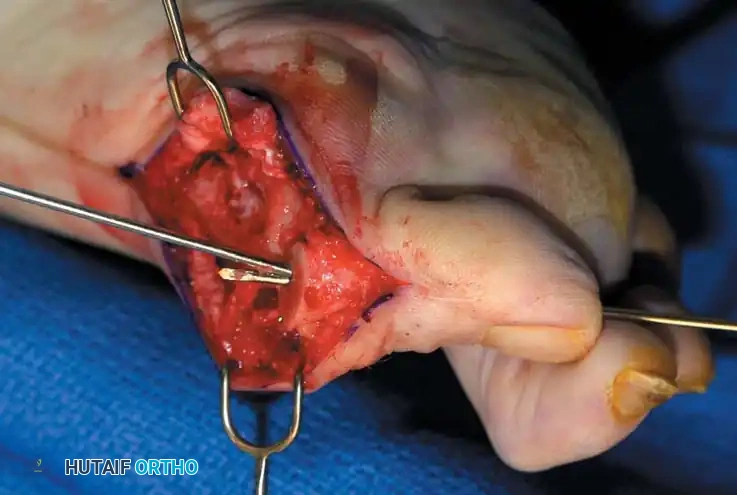 Disorders of the Hallux Surgical Diagram