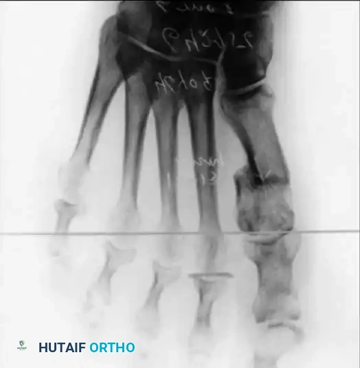 Fig. 78-33 A and B, Anteroposterior and lateral weight bearing radiographs of Mitchell procedure that, through excessive shortening and dorsally angulated malunion, has resulted in transfer metatarsalgia. This biplanar deformity is most diffi cult to correct.