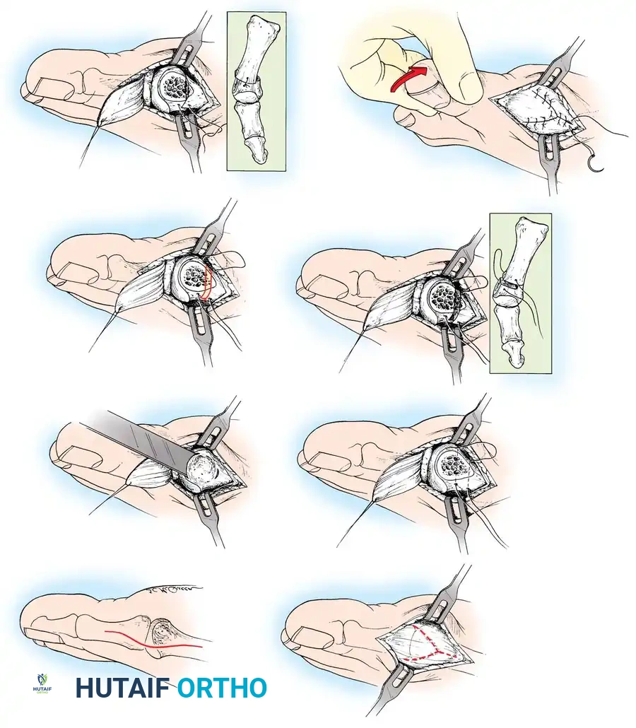Disorders of the Hallux Surgical Diagram
