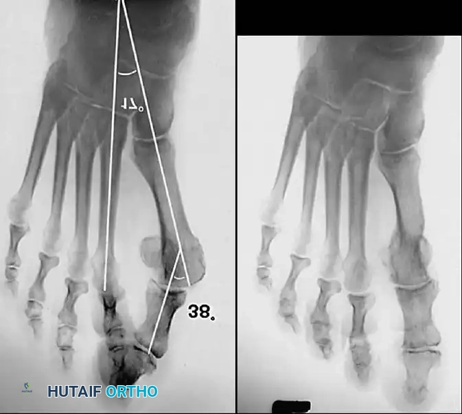 Disorders of the Hallux Surgical Diagram