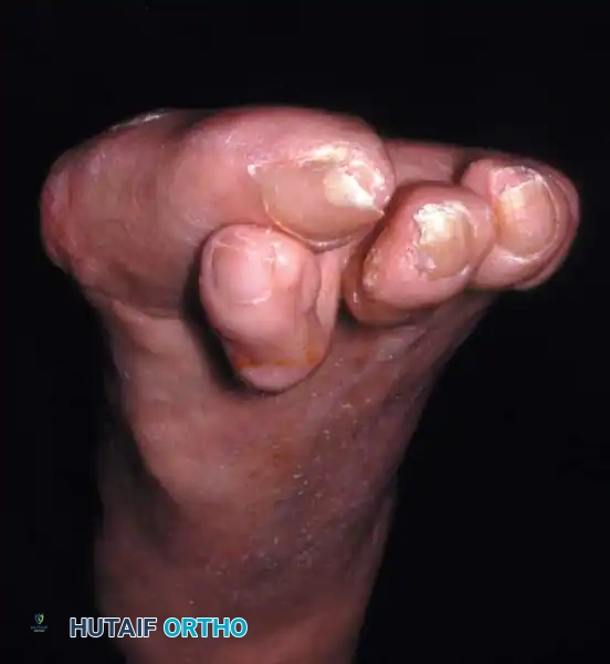 Fig. 78-36 A, This degree of deformity (left foot) is diffi cult to correct with standard chevron osteotomy when apex is at subchondral bone of capital fragment. B, Standing radiograph of left foot before correction. C, Standing radiograph 1 year after chevron osteotomy, release of adductor hallucis, Akin osteotomy, and correction of hammer toe.