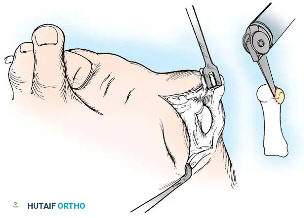 Disorders of the Hallux Surgical Diagram