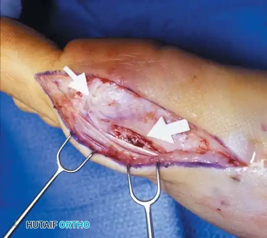 Disorders of the Hallux Surgical Diagram