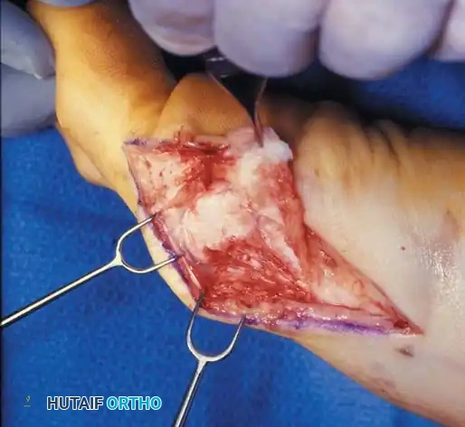 Disorders of the Hallux Surgical Diagram