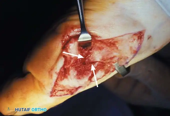 4-5 mm shift of capital fragment laterally