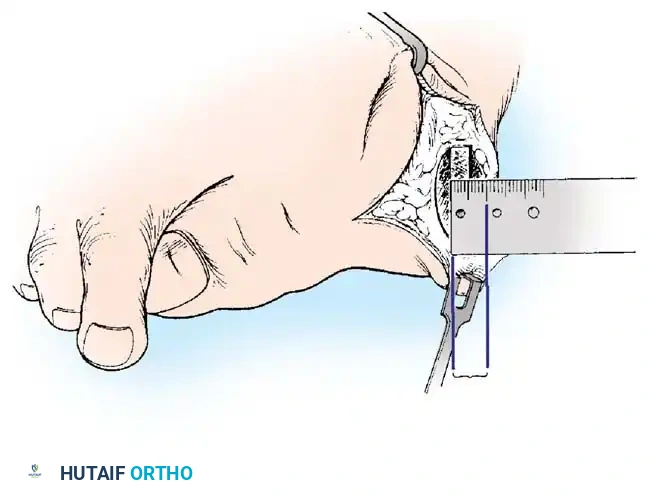 4-5 mm shift of capital fragment laterally