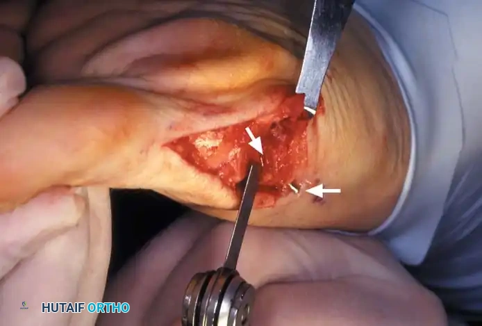 Disorders of the Hallux Surgical Diagram