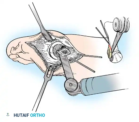 Disorders of the Hallux Surgical Diagram