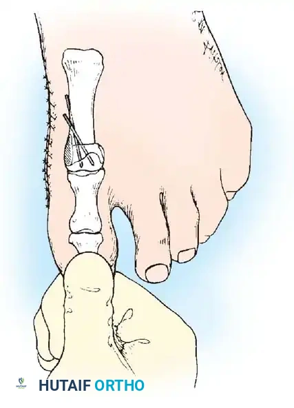 Disorders of the Hallux Surgical Diagram