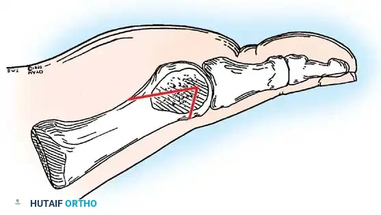 Disorders of the Hallux Surgical Diagram