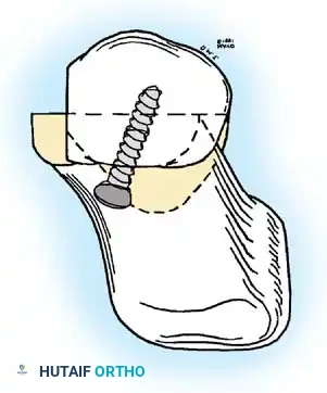 Disorders of the Hallux Surgical Diagram