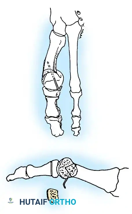 Disorders of the Hallux Surgical Diagram