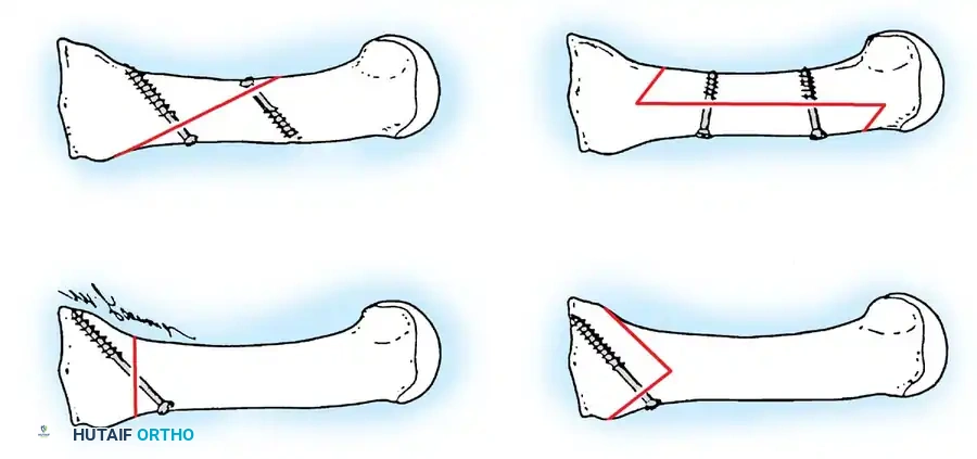 Disorders of the Hallux Surgical Diagram