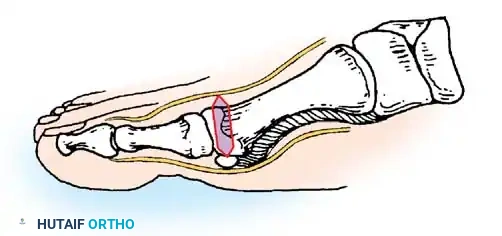 Dorsal digital nerve