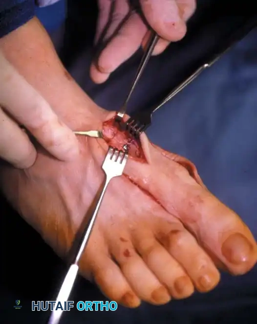 Fig. 78-41, cont’d F, Knife blade is in metatarsocuneiform joint, and two lines marked on metatarsal represent osteotomy site (proximal line) and location of screw for fi xation (distal line) . G, Final position of screw and position of metatarsal after correction of fi rst metatarsal. H, Note Freer elevator is displacing or rotating proximal fragment medially, whereas fi rst metatarsal head and distal fragment are being angulated laterally by manual pressure. I, Postoperative dressings after correction of hallux valgus. Metatarsal heads are fi rmly bound together, and great toe is rotated to keep sesamoids aligned beneath metatarsal head. Right toe should be dressed in counterclockwise direction and left toe in clockwise direction when standing at foot of bed. ( A-D from Mann RA, Coughlin MJ: The video textbook of foot and ankle surgery , St Louis, 1991, Medical Video Productions; E and I from Mann RA, Coughlin MJ, eds: Surgery of the foot and ankle , 6th ed, St Louis, 1993, Mosby.)