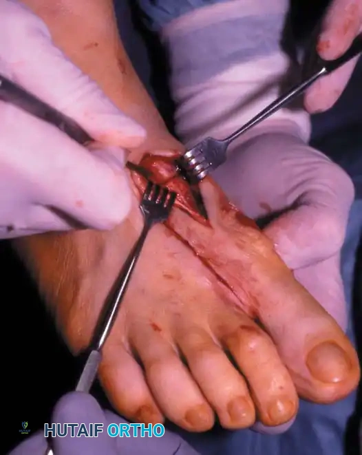 Fig. 78-41, cont’d F, Knife blade is in metatarsocuneiform joint, and two lines marked on metatarsal represent osteotomy site (proximal line) and location of screw for fi xation (distal line) . G, Final position of screw and position of metatarsal after correction of fi rst metatarsal. H, Note Freer elevator is displacing or rotating proximal fragment medially, whereas fi rst metatarsal head and distal fragment are being angulated laterally by manual pressure. I, Postoperative dressings after correction of hallux valgus. Metatarsal heads are fi rmly bound together, and great toe is rotated to keep sesamoids aligned beneath metatarsal head. Right toe should be dressed in counterclockwise direction and left toe in clockwise direction when standing at foot of bed. ( A-D from Mann RA, Coughlin MJ: The video textbook of foot and ankle surgery , St Louis, 1991, Medical Video Productions; E and I from Mann RA, Coughlin MJ, eds: Surgery of the foot and ankle , 6th ed, St Louis, 1993, Mosby.)