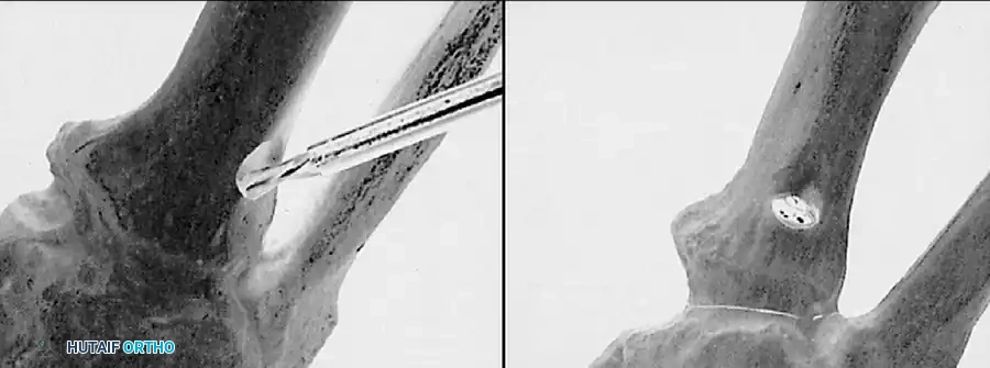 Disorders of the Hallux Surgical Diagram