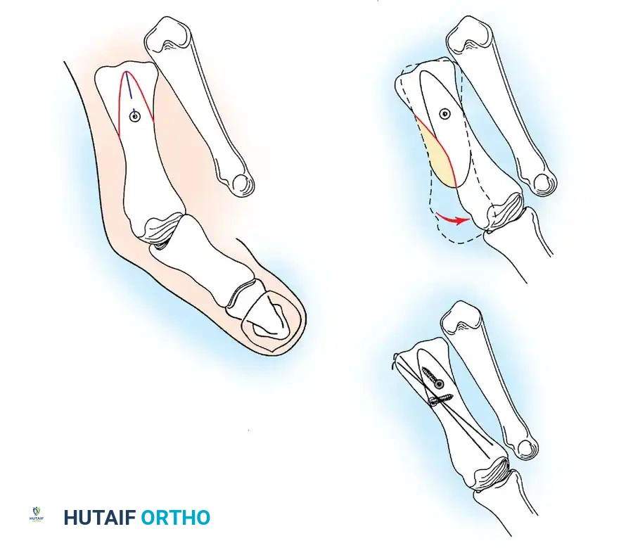 1st screw dorsal to plantar