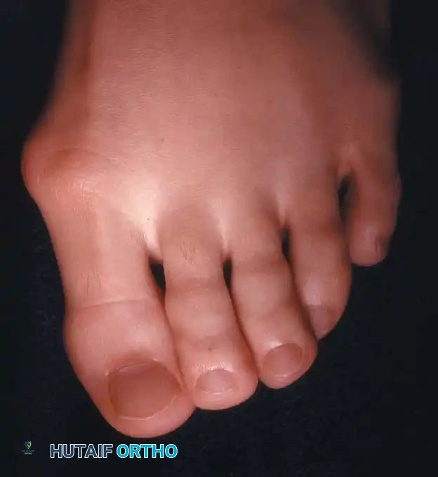 Fig. 78-51 A, Mild hallux valgus and signifi cant hallux valgus interphalangeus is a deformity that can be corrected with an Akin osteotomy. B, Deformity that is not appropriate for Akin osteotomy.