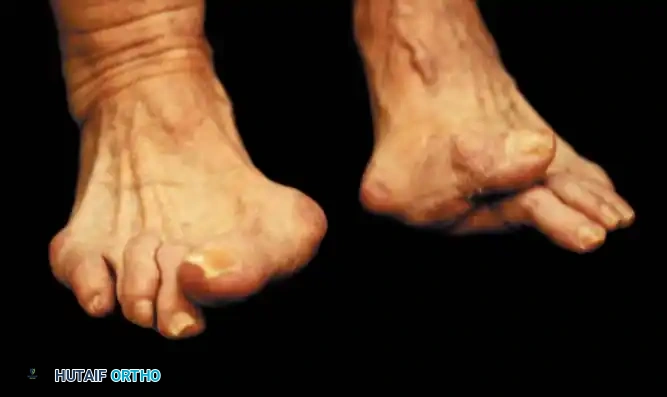 Fig. 78-54 Severe hallux valgus is good indication for arthrodesis of fi rst metatarsophalangeal joint, particularly in recurrent hallux valgus after previous attempt at correction (left foot).