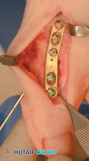 Fig. 78-56 Technique for arthrodesis of fi rst metatarsophalangeal joint. A, Dorsal skin incision. B, Excision of metatarsal head. C, Fusion site placed in 15 to 20 degrees of valgus. D, Approximately 30 degrees of dorsifl exion in relation to metatarsal shaft or approximately 10 to 15 degrees of dorsifl exion in relation to fl oor. E, Two parallel cuts are made. F, Six-hole, onequarter tubular plate in place. (From Mann RA, Coughlin MJ, eds: Surgery of the foot and ankle, 7th ed, St Louis, 1999, Mosby; C and D from Mann RA, Coughlin MJ: The video textbook of foot and ankle surgery , St Louis, 1991, Medical Video Productions.)