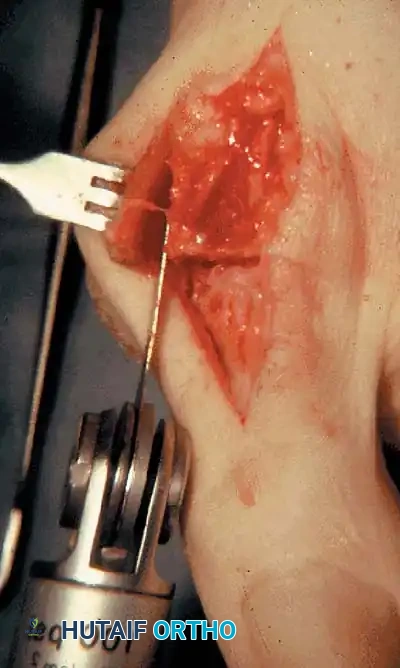 Disorders of the Hallux Surgical Diagram