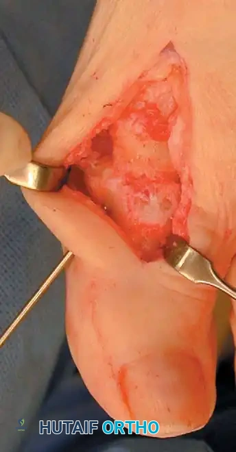 Fig. 78-56 Technique for arthrodesis of fi rst metatarsophalangeal joint. A, Dorsal skin incision. B, Excision of metatarsal head. C, Fusion site placed in 15 to 20 degrees of valgus. D, Approximately 30 degrees of dorsifl exion in relation to metatarsal shaft or approximately 10 to 15 degrees of dorsifl exion in relation to fl oor. E, Two parallel cuts are made. F, Six-hole, onequarter tubular plate in place. (From Mann RA, Coughlin MJ, eds: Surgery of the foot and ankle, 7th ed, St Louis, 1999, Mosby; C and D from Mann RA, Coughlin MJ: The video textbook of foot and ankle surgery , St Louis, 1991, Medical Video Productions.)