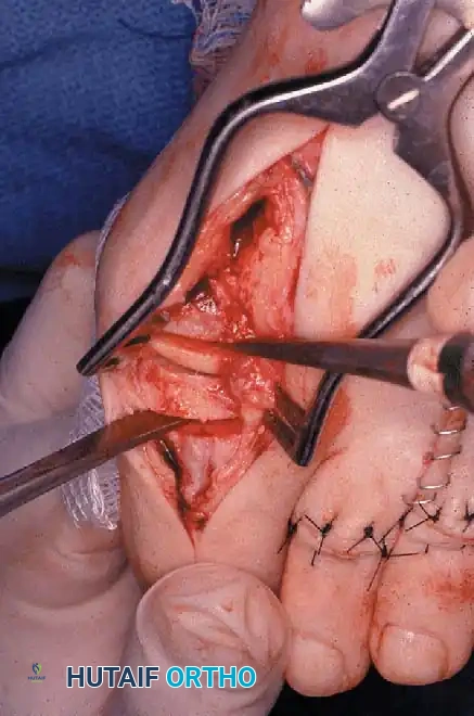 Disorders of the Hallux Surgical Diagram