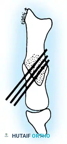 Fig. 78-58 Smith technique. (Courtesy of R.W. Smith, MD.)