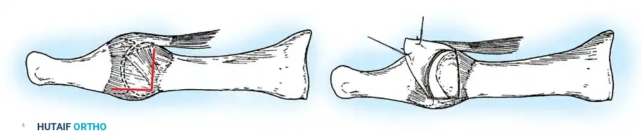 Disorders of the Hallux Surgical Diagram