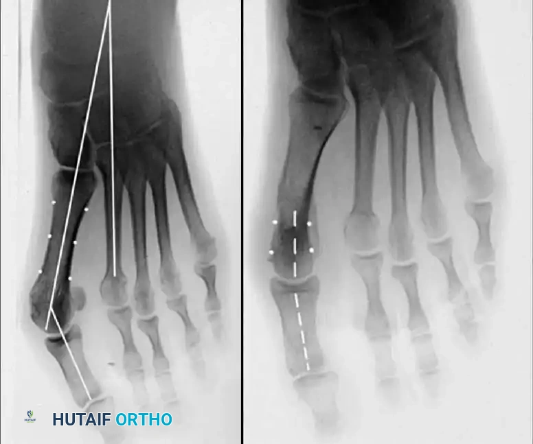 Disorders of the Hallux Surgical Diagram
