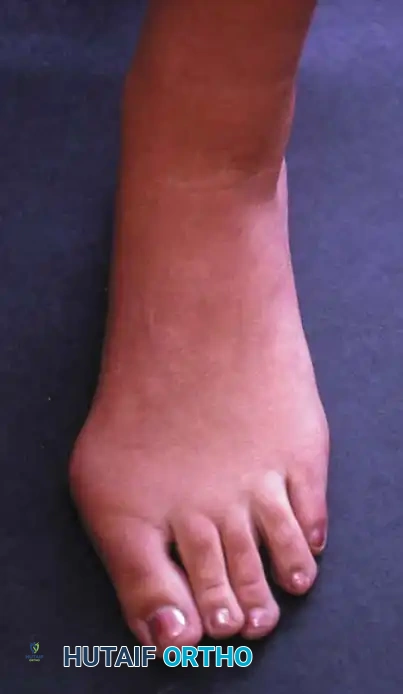 Fig. 78-61 A, Moderately severe hallux valgus in 17-year-old patient. B, Note congenital shortening of second metatarsal on radiograph. C, After chevron osteotomy and adductor release.