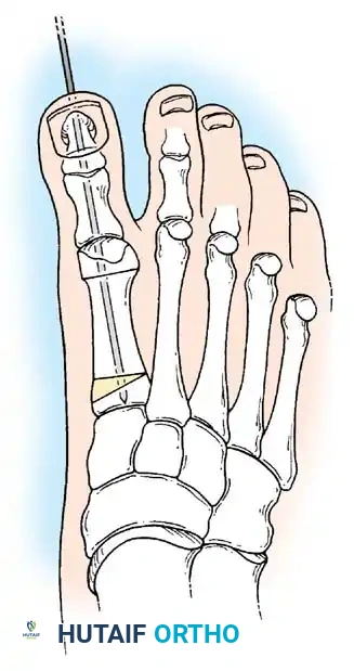 Fig. 78-63 Intramedullary fi xation with Steinmann pin secures longitudinal alignment of metatarsal and both phalanges.