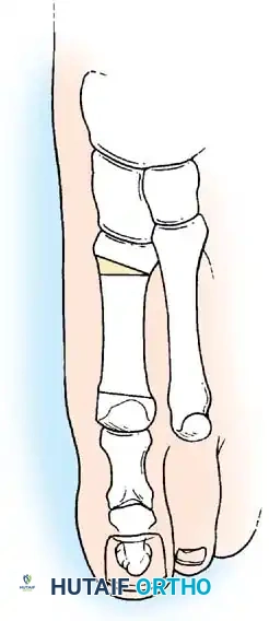 Disorders of the Hallux Surgical Diagram